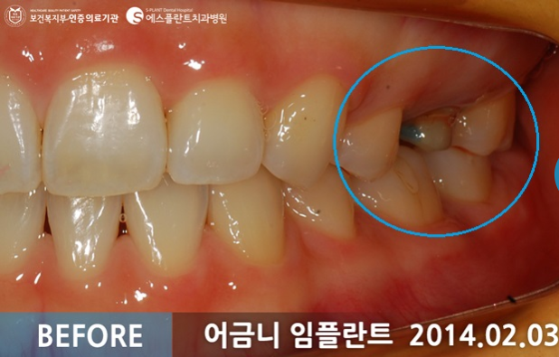 어금니 임플란트 시술 전