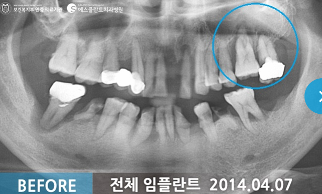 전체 임플란트 시술 전
