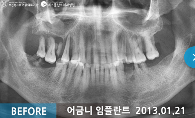어금니 임플란트 시술 전