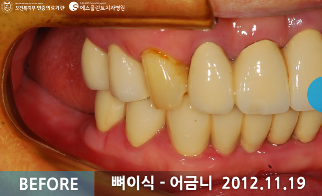 뼈이식 임플란트 시술 전