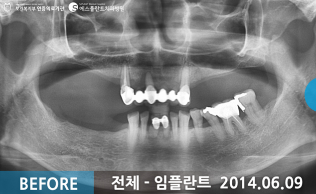 전체 임플란트 시술 전