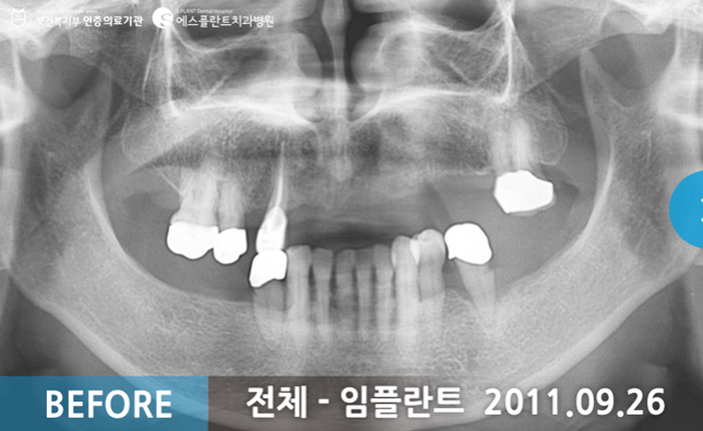 전체 임플란트 시술 전